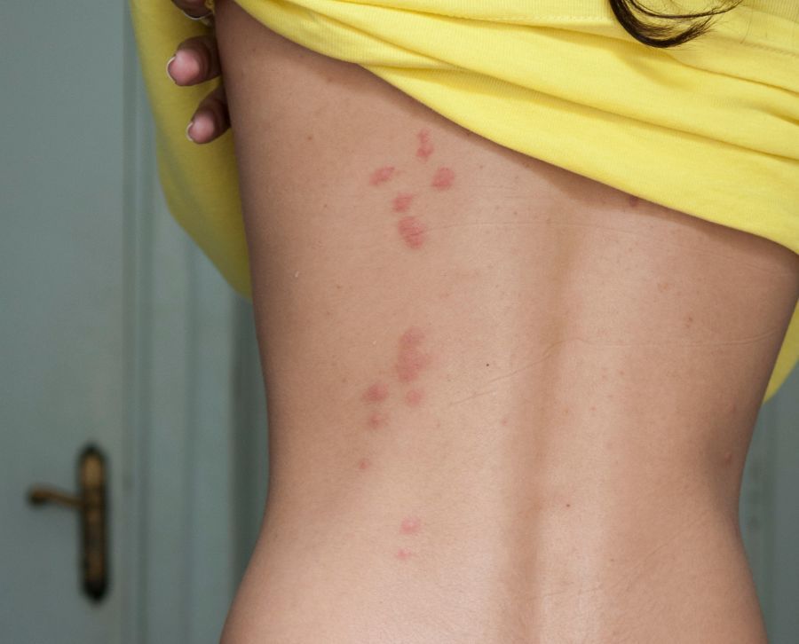 picadura de chinches